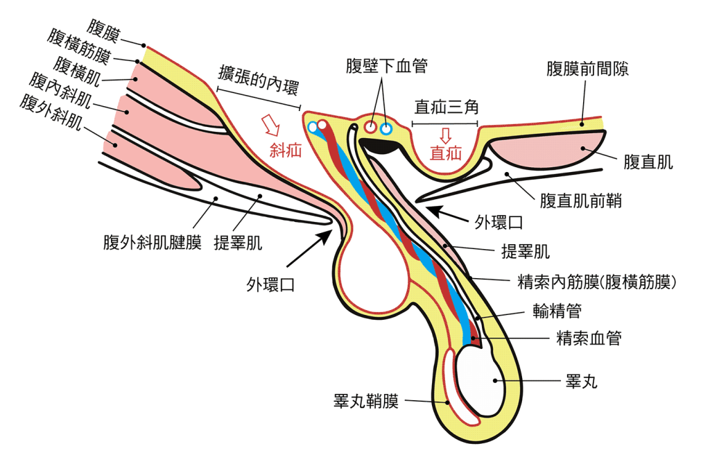 右腹壁橫切面顯示的腹股溝疝氣情況：腹股溝直疝與斜疝兩種在解剖上的位置