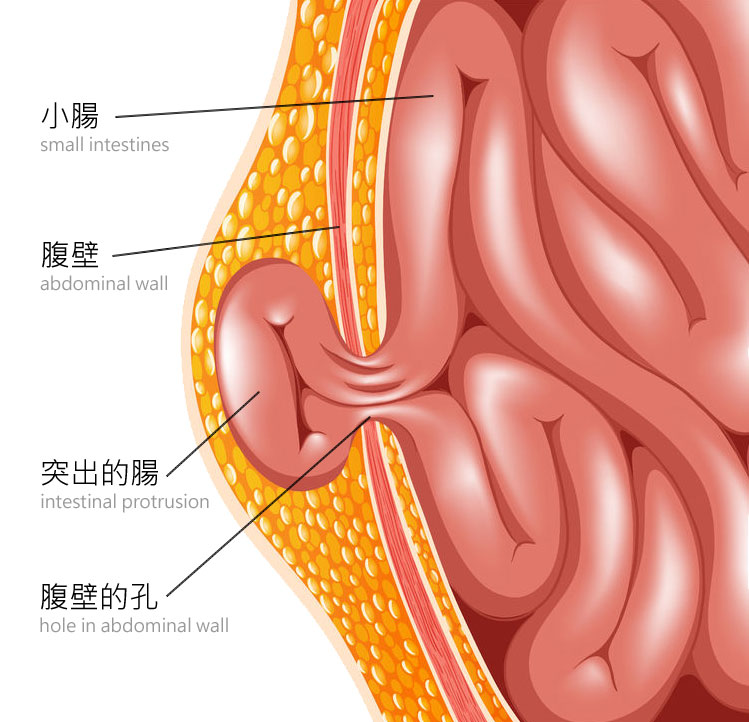 疝氣是什麼？身體器官（較多病例是小腸）通過包含它的肌肉或組織的開口或薄弱處凸出時，就會發生疝氣。