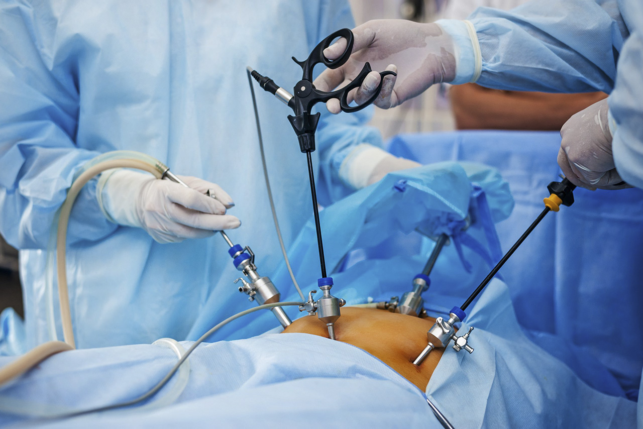 腹腔鏡疝氣手術的優點與缺點
