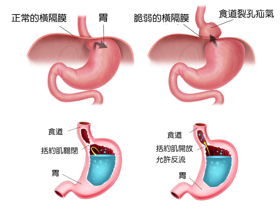 食道裂孔疝氣的原因以及胃酸逆流