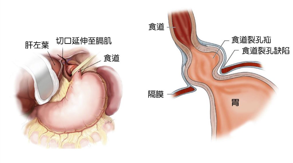 食道裂孔疝氣的解剖