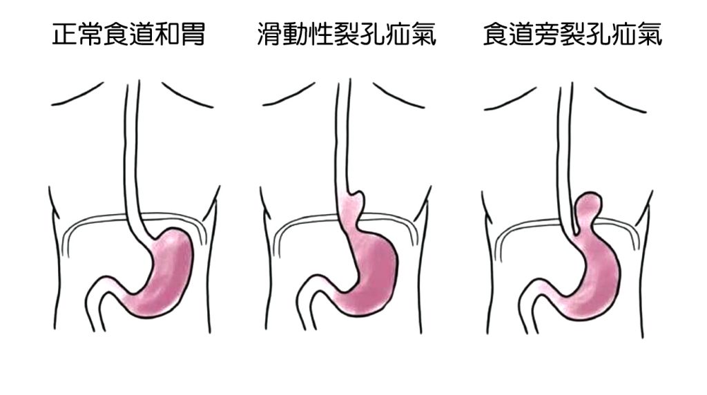 食道裂孔疝簡圖