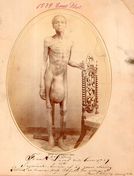 男性，有 69 年腹股溝疝病史。患者弗蘭克·蘭姆 (Frank Lamb) 是北卡羅來納州的一名奴隸，自 9 歲起就患有左側腹股溝疝氣。儘管如此，他還是被迫每天從事艱苦的勞動。結果，形成了重要的腹股溝陰囊疝囊。來源：National Museum of Health and Medicine。