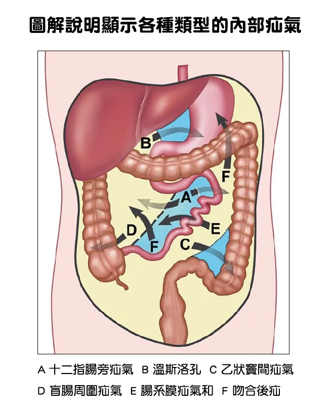 疝氣是什麼？圖解說明顯示各種類型的內部疝氣。這類疝氣通常發生在腹腔，需要外科、肝膽腸胃科等進一步透過儀器才能確診。與常見的外疝氣不太相同。